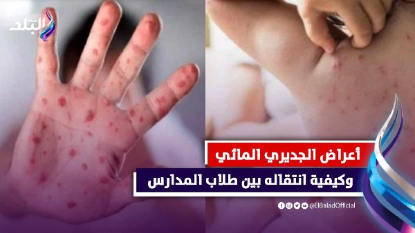 الجدري المائي: طرق فعالة لعلاج 24 طالبًا مصابًا