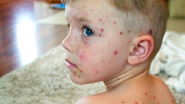 زيادة حالات الجديري المائي في مدرسة المنوفية إلى 24 وعزل المصابين لمدة 10 أيام مع تطهير الفصول