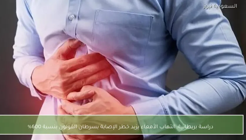 دراسة بريطانية: التهاب الأمعاء يزيد خطر الإصابة بسرطان القولون بنسبة 600%