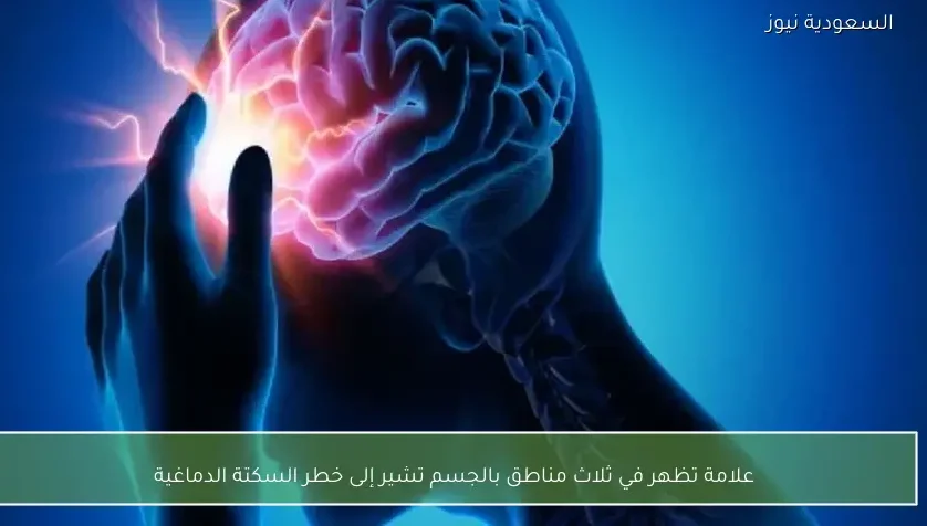 علامة تظهر في ثلاث مناطق بالجسم تشير إلى خطر السكتة الدماغية