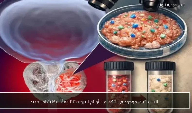 البلاستيك موجود في 90% من أورام البروستاتا وفقًا لاكتشاف جديد